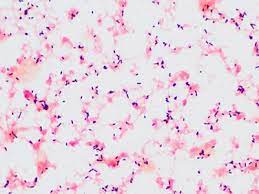 Listeria monocytogenes is a bacterium that causes listeriosis, a disease that can have severe consequences for particular groups of the population. Listeria Meningitis An Inconsistent Organism Causing An Inconsistent Disease The American Journal Of Medicine
