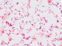 The video below shows these rocket tails in action. Listeria Meningitis An Inconsistent Organism Causing An Inconsistent Disease The American Journal Of Medicine