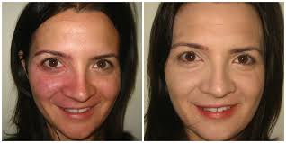 Makeup To Cover Birthmark or Portwine Stain