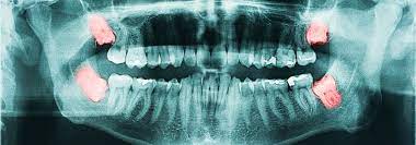 Oral and maxillofacial surgery is the specialty of dentistry that includes the diagnosis and surgical and related treatment of diseases, injuries, and defects involving both the functional and esthetic aspects of the hard and soft tissues of the head, mouth, teeth, gums, jaws and neck. Oral And Maxillofacial Surgery Penn Dental Medicine