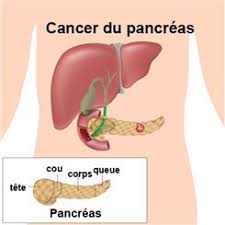Une fatigue constante, une perte de poids soudaine et inexpliquée, un le cancer du pancréas est une maladie qui affecte aussi bien les hommes que les femmes, et peut apparaître à n'importe quel âge de la vie. Cancer Du Pancreas Symptomes Traitement Definition Docteurclic Com