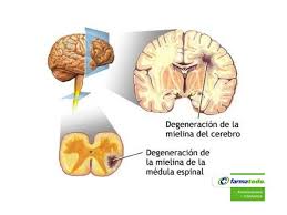 La esclerosis múltiple (em) es una enfermedad autoinmunitaria que afecta al cerebro y a la médula espinal. Farmacias Te Dice Cual Es Causa Que Provoca La Esclerosis Multiple Grupo Farmatodo 2 Multiple Sclerosis Esclerosis Multiple Bee Pollen