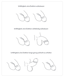 Die unterschiedlichen Arten von Erektionsstörungen | Spring