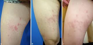 Image result for pruritic urticarial papules and plaques of pregnancy