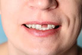 Why You Must Act Fast When A Tooth Gets Knocked Out Cleveland Clinic