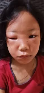 Hello fellow lupus warriors! How many years have you been living with lupus?