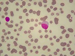 Presentano numero di megacariociti nella norma, vita media delle piastrine inferiore ai circa dieci giorni di norma e turn over delle piastrine aumentato. Striscio Ematico In Un Gatto Pancitopenico