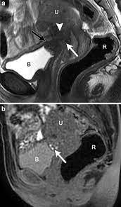 Endometriosis, vaginal endometriosis, mri, radiology, diagnosis. Endometriosis Mri Lexicon Consensus Statement From The Society Of Abdominal Radiology Endometriosis Disease Focused Panel Springerlink