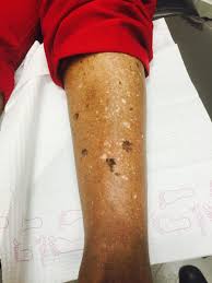 Image result for Pigment stains on the shin
