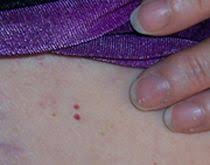These little, bright red growths are caused by an overgrowth of small blood vessels in a particular area. Cherry Angiomas Find The Real Cause Health And Nutrition Natural Health Remedies Health Remedies