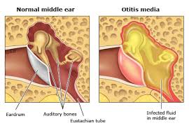 patient education ear infections otitis media in children