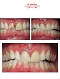 This New Patient Emergency Came In With A Shattered Crown On A Front Tooth We Were Able To Prepare His Tooth For A New Front Teeth Custom Shades Dental Crowns