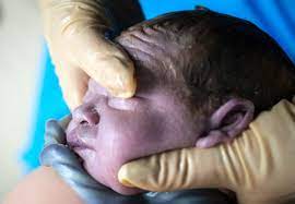 Une syphilis maternelle non traitée entraîne soit la mort in utero (40%), soit une syphilis congénitale (40. Accouchement Le Cordon Ombilical Autour Du Cou Un Danger Pour Les Bebes Igl Infos Grands Lacs