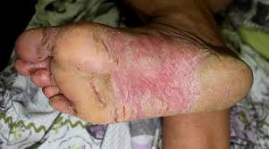 Image result for pompholyx soles of feet