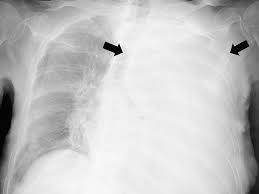 Image result for Pleural Tuberculosis