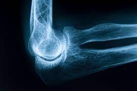 OsteoDiagnosis AI Mobile App