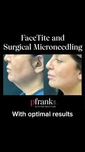 Achieve your aesthetic goals in a single session with the 🔥 combination of  #FaceTite and #Morpheus8 🙌 Original content is @drpauljarrodfrank  #LinkinBio to learn more about #FaceTite and find a ...