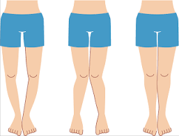Pin By Cigal Shaham On Kids Health Bow Legged Correction Knock Knees Bow Legged