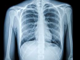 Can lung cancer be mistaken for bronchitis. Chest X Ray For The Diagnosis Of Lung Cancer