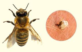 Hun har sendt bilder av bittene, som hun forteller begynte som små og røde, men som. 10 Vanlige Insektsbitt Alle Burde Laere Seg A Kjenne Igjen