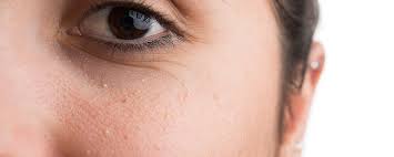 Milia bisa dialami oleh siapa. Cara Menghilangkan Bintik Bintik Kecil Di Wajah Dengan Cepat