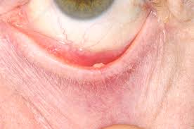 Image result for milium cyst on eyelid