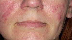 Rosacea Focus Arztsuche