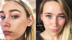 Vitamin c provides powerful antioxidant protection and supports immune function* Reddit User Shares Her Acne Clearing Skincare Routine For Glowing Skin Health Com