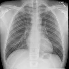 At the description of these shadows it is. Isolated Anterior Mediastinal Tuberculosis In An Immunocompetent Patient Bmc Pulmonary Medicine Full Text