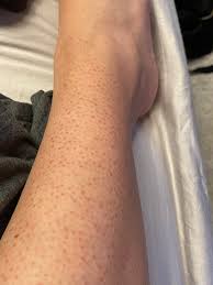 Image result for Keratosis pilaris