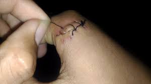 Tips biar luka caesar cepat sembuh. Cara Melepas Benang Luka Jahitan Bekas Digigit Ular Phyton Youtube