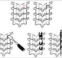 How and When to Use Hooks to Improve Deformity Correction ...