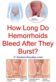 Piles Are Usually Not Severe But They Can Be Troublesome And Make Day To Day Live Hard How Much Time P Bleeding Hemorrhoids Hemorrhoids Treatment Hemorrhoids