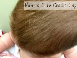 Image result for Cradle Cap