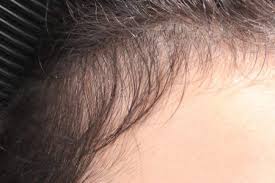 La Perdida Del Cabello Como Consecuencia Del Coronavirus