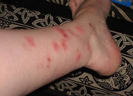 How To Get Rid Of Bed Bug Bites Is Not The Question To Be Answered First Kulit