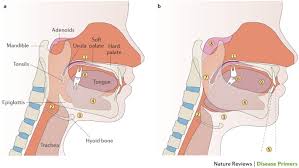 Image result for Obstructive Sleep Apnea