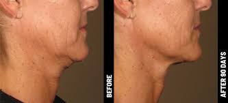 Nov 11, 2020 · ultherapy is a noninvasive skin tightening procedure. Before After Brow Neck Upper Chest Chin Lift Ultherapy