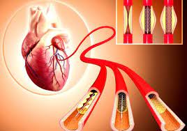 Cand varful ajunge in zona obstructionata a arterei coronare aproximativ 90% dintre persoanele care au fost supuse unei angioplastii coronariene transluminale percutanate sunt candidate pentru plasarea unui stent la inima. ViaÅ£a Cu Stent Ce Reguli Trebuie SÄƒ Respecte Pacientul Clinica De Cardiologie Cardioclass