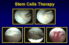 Microfracture For Cartilage Defects Dr Hc Chang
