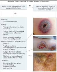 Image result for Pyoderma Gangrenosum