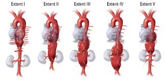 Classic dissection with true and false lumen. Dr Bogdan Vintila Vascular Blog