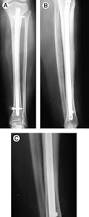 Image result for Tibia Stress Fracture