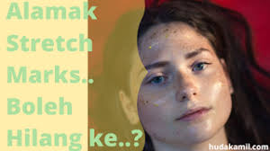 Ada tak disini sesiapa yang mempunya kawan yang mengalami masalah jerawat dan kesan parut yang serius? 5 Tips Untuk Hilangkan Parut Secara Semulajadi Stretch Marks Tips Shaklee