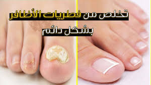فطريات الاظافر الحل النهائي لعلاجها Youtube
