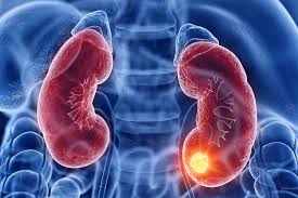 Skin cancer is the most common cancer in the united states. Understanding Kidney Cancer Its Signs Symptoms Line Of Treatment Epic Health