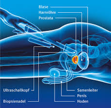 Prostatakrebs Prostatakarzinom Deutsche Krebshilfe
