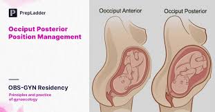 Image result for Manual Rotation in Occipitoposterior Presentation