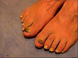Image result for Onychogryphosis feet