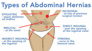 Some people who are allergic to shell fish may also be. About Hernias The Hernia And Reflux Center